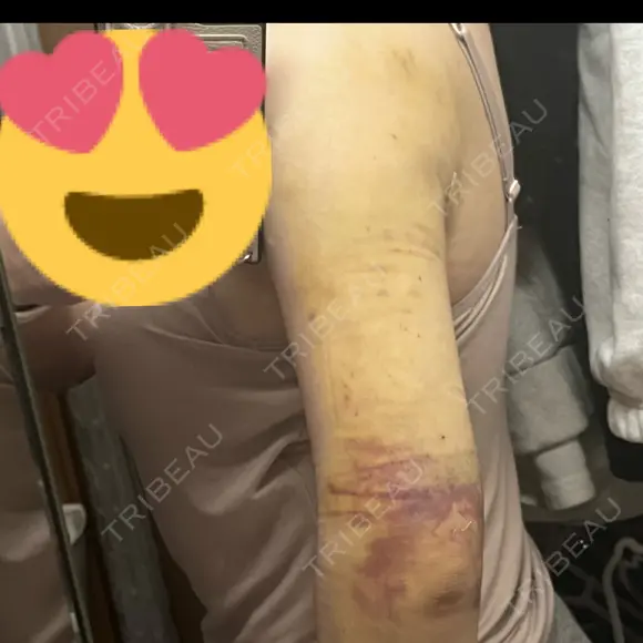 脂肪吸引（二の腕） 藤・ナチュレ美容クリニック 銀座院 DAY 4 メイン用
