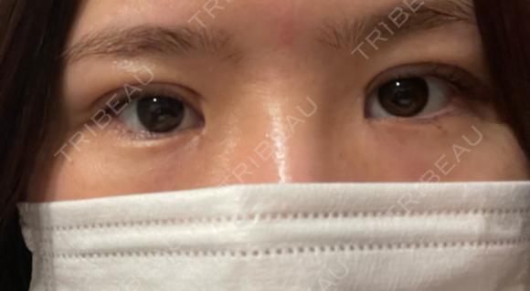 二重切開 恵聖会クリニック 心斎橋院 DAY 21 メイン用