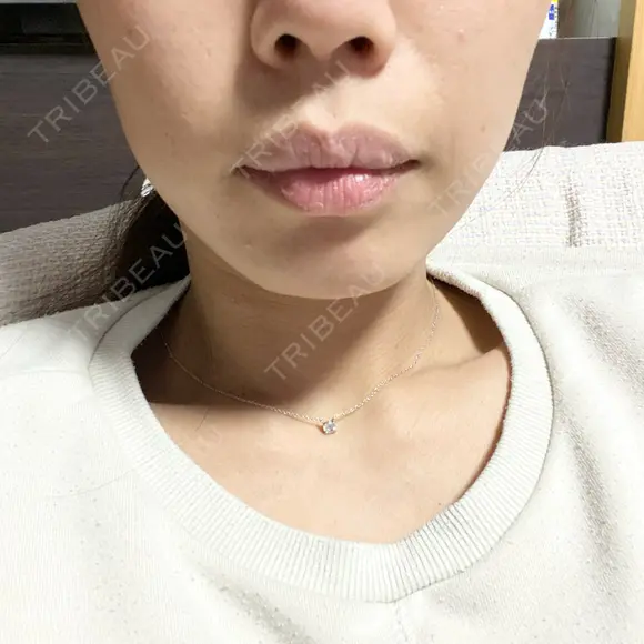 ボトックス（エラ・小顔） 一宮美容クリニック AFTER メイン用