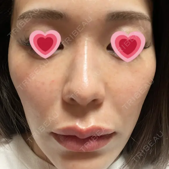 水光注射（ハリ・美肌） 赤羽ここちクリニック DAY 4 メイン用