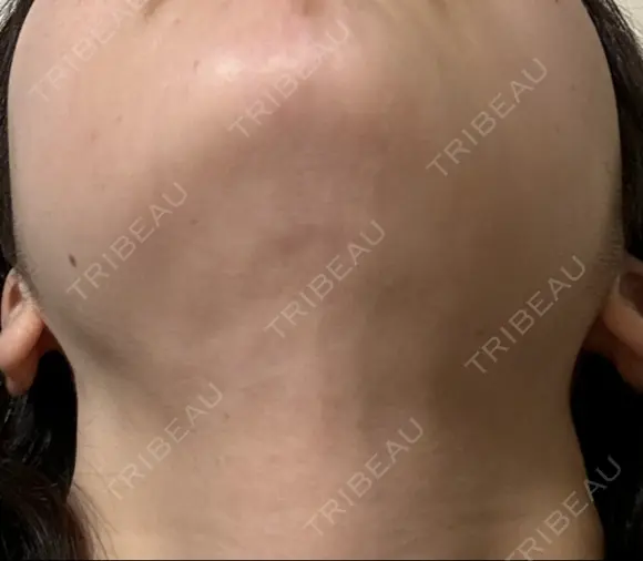 脂肪吸引注射（顔） イテウォンビューティークリニック 名古屋栄院 DAY 112 メイン用