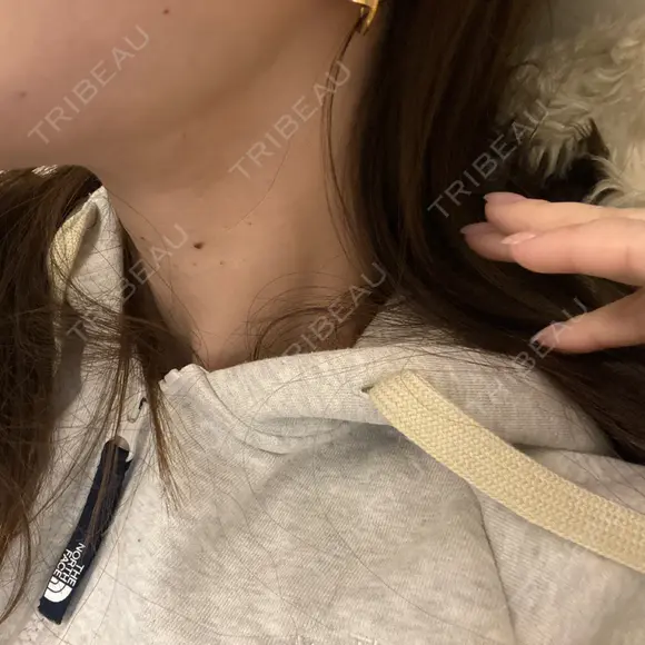 マイクロボトックス 日本美容・医療クリニック 六本木院 AFTER メイン用