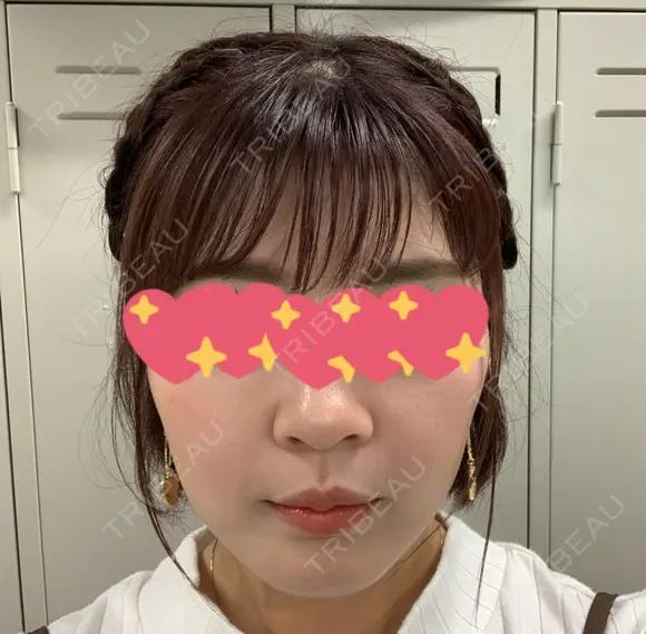 ヴェルヴェットスキン Olino美容外科・美容皮膚科 AFTER メイン用