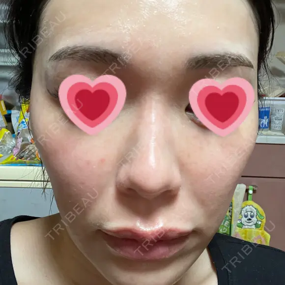 水光注射（ハリ・美肌） 赤羽ここちクリニック DAY 6 メイン用