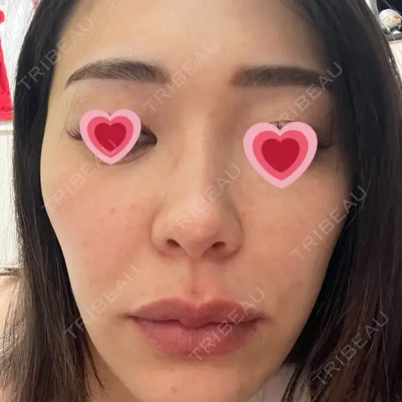 水光注射（ハリ・美肌） 赤羽ここちクリニック DAY 7 メイン用