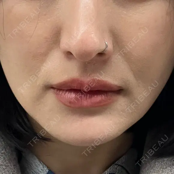 ヒアルロン酸注入（あご） 松倉クリニック 表参道 DAY 7 メイン用