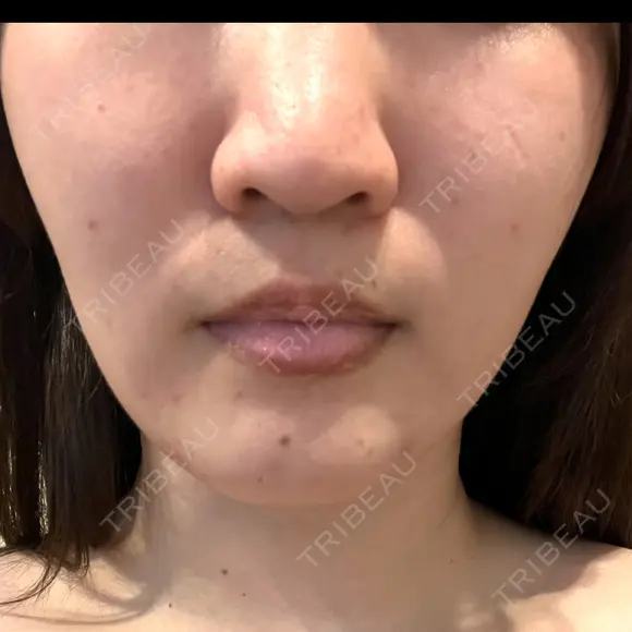 ルメッカ ルラ美容クリニック 大宮院 / ルラスキンクリニック 大宮院 AFTER メイン用