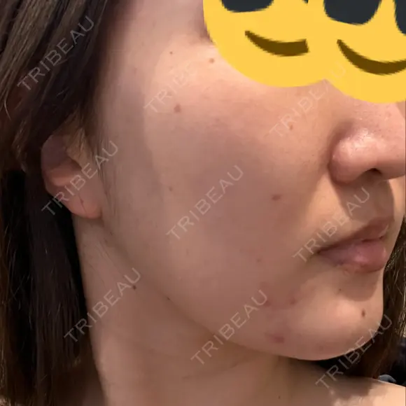 ルメッカ ルラ美容クリニック 大宮院 / ルラスキンクリニック 大宮院 DAY 34 メイン用