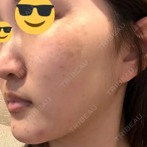 ルメッカ ルラ美容クリニック 大宮院 / ルラスキンクリニック 大宮院 DAY 34 メイン用