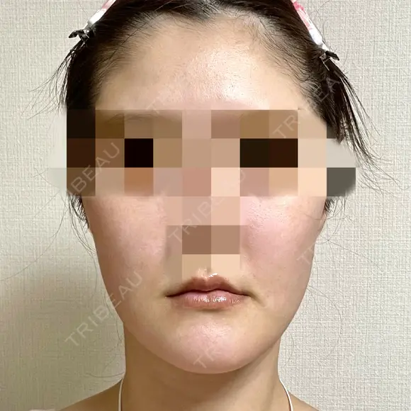 脂肪吸引（顔） 銀座マイアミ美容外科 DAY 36 メイン用