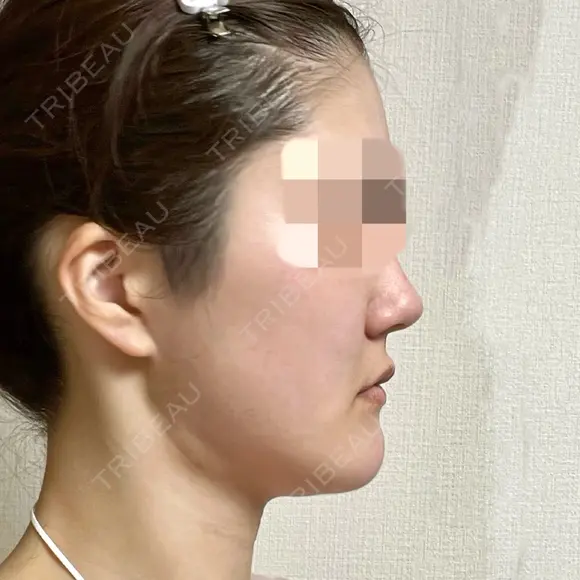 脂肪吸引（顔） 銀座マイアミ美容外科 DAY 36 メイン用