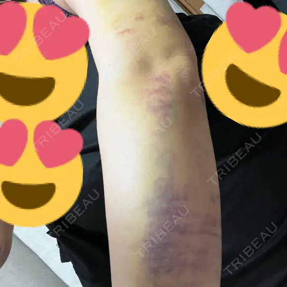 脂肪吸引（二の腕） 藤・ナチュレ美容クリニック 銀座院 DAY 6 メイン用