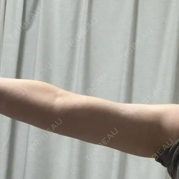 脂肪吸引（二の腕） / 脂肪吸引（脚） / ボトックス（ふくらはぎ） / ボトックス（二の腕） Mods Clinic（モッズクリニック） 福岡院 DAY 99 メイン用