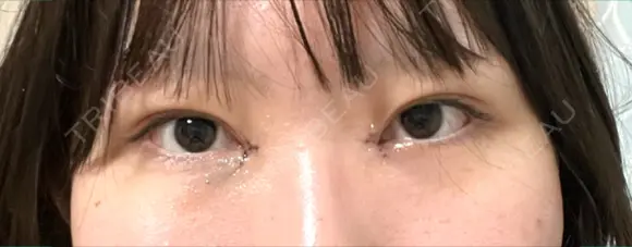 二重埋没 / 目頭切開 シンデレラ＆ダヴィンチクリニック DAY 0 メイン用