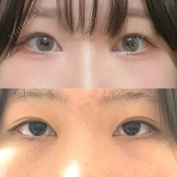 二重埋没 / 目頭切開 シンデレラ＆ダヴィンチクリニック AFTER メイン用