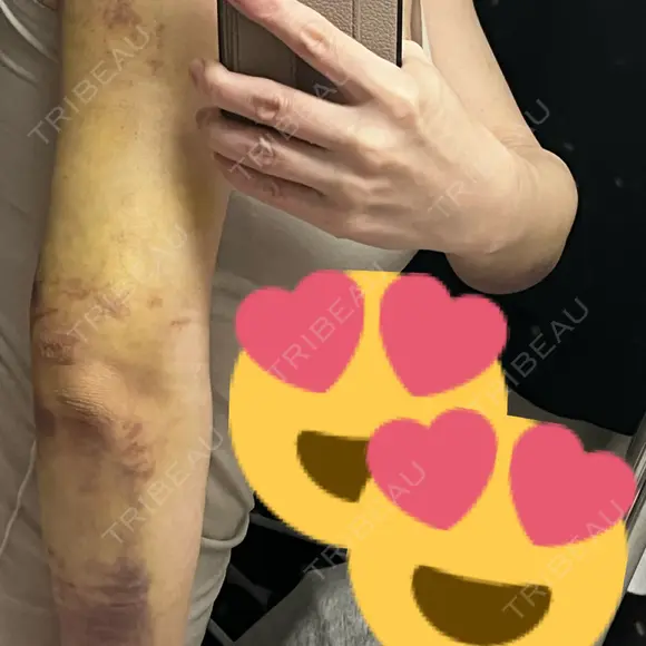 脂肪吸引（二の腕） 藤・ナチュレ美容クリニック 銀座院 DAY 7 メイン用