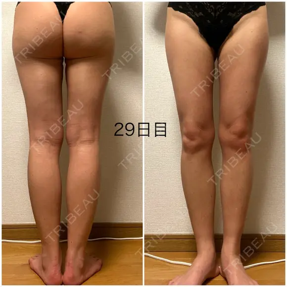脂肪吸引（脚） / 豊胸（脂肪注入） GAYA body design clinic DAY 29 メイン用