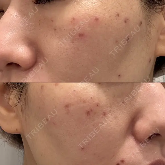 ピコレーザートーニング（美白・肝斑） / ピコスポット BISIN GINZA CLINIC DAY 0 メイン用