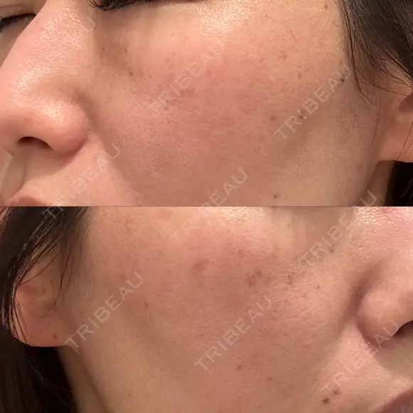 ピコレーザートーニング（美白・肝斑） / ピコスポット BISIN GINZA CLINIC AFTER メイン用