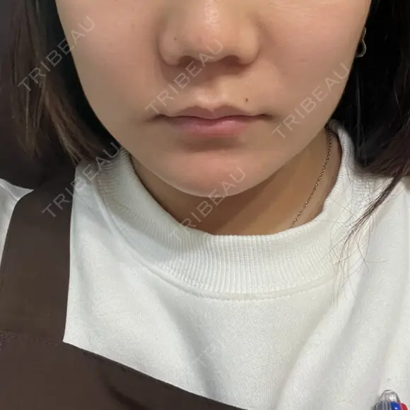 ボトックス（エラ・小顔） 湘南美容クリニック 東京蒲田院 DAY 2 メイン用