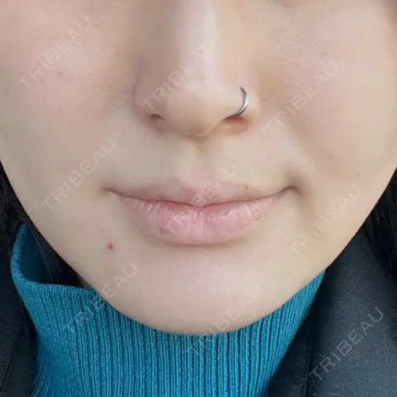 ヒアルロン酸注入（あご） 松倉クリニック 表参道 DAY 11 メイン用