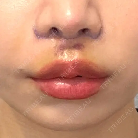 人中短縮 / その他（鼻） 聖心美容クリニック 六本木院 DAY 6 メイン用