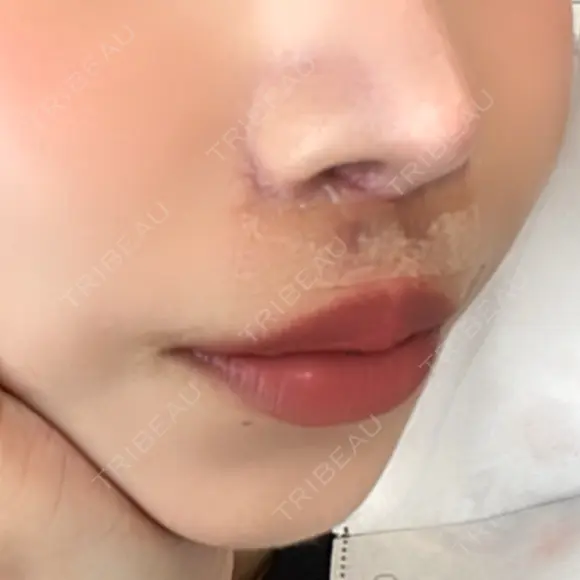 人中短縮 / その他（鼻） 聖心美容クリニック 六本木院 DAY 8 メイン用