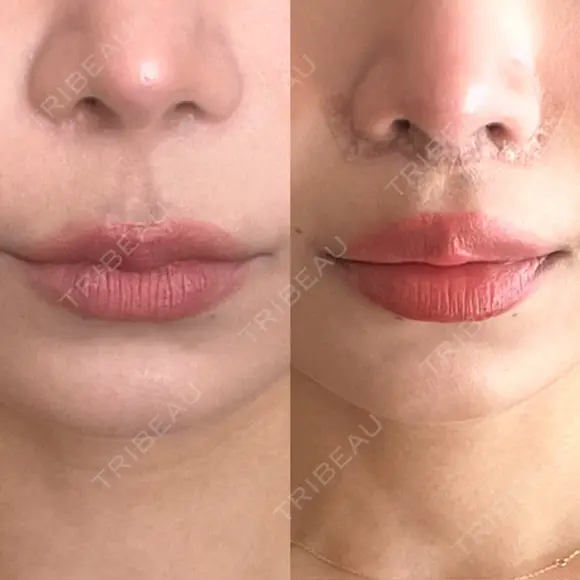 人中短縮 / その他（鼻） 聖心美容クリニック 六本木院 DAY 12 メイン用