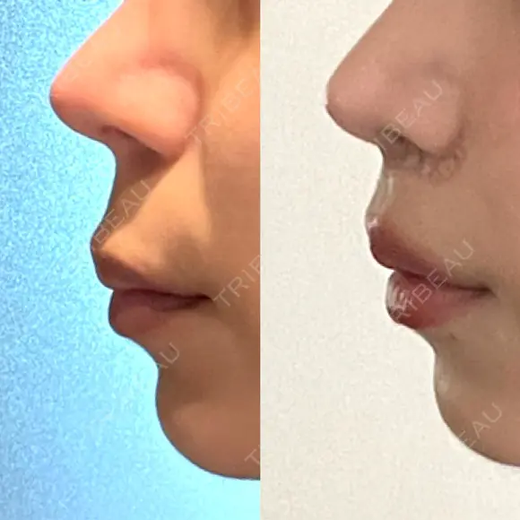 人中短縮 / その他（鼻） 聖心美容クリニック 六本木院 DAY 12 メイン用