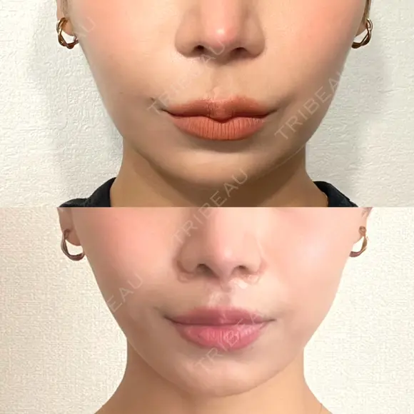 人中短縮 / その他（鼻） 聖心美容クリニック 六本木院 DAY 17 メイン用