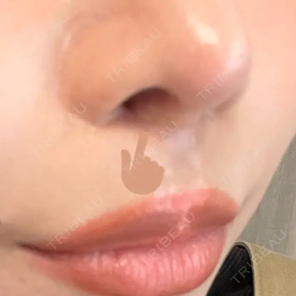 人中短縮 / その他（鼻） 聖心美容クリニック 六本木院 DAY 46 メイン用