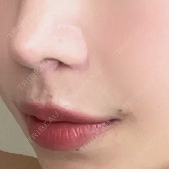 人中短縮 / その他（鼻） 聖心美容クリニック 六本木院 AFTER メイン用