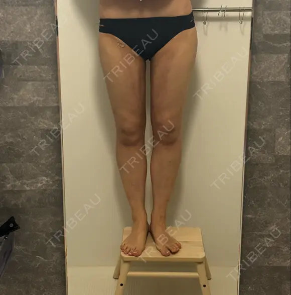 脂肪吸引（脚） 湘南美容クリニック 京都院 DAY 41 メイン用