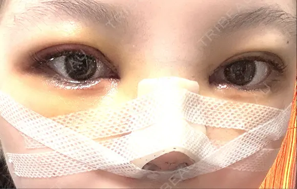 二重埋没 / 目頭切開 / 鼻尖形成（切開） / 軟骨移植 / 眉間プロテーゼ / 鼻尖縮小 グローバルビューティークリニック 大阪院 DAY 4 メイン用