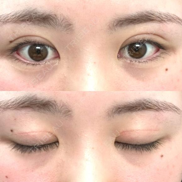 二重切開 つだ美容外科クリニック AFTER メイン用