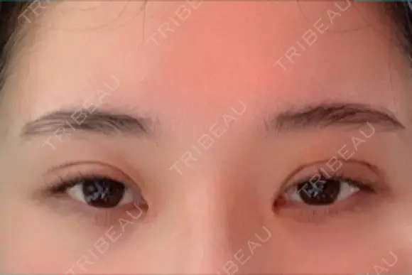 目頭切開 ziz CLINIC DAY 26 メイン用