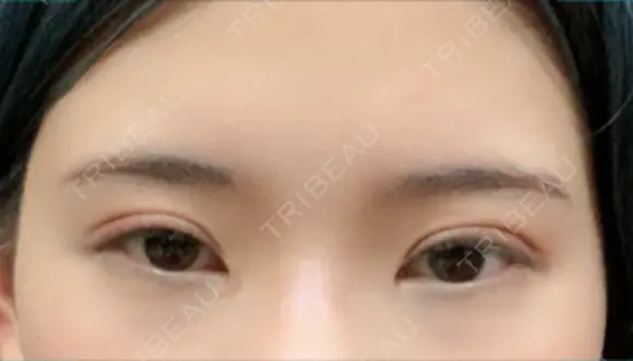 目頭切開 ziz CLINIC AFTER メイン用