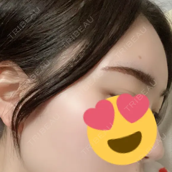 アートメイク（眉） LEAGRANT CLINIC 中目黒 DAY 1 メイン用
