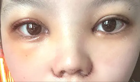 二重埋没 / 目頭切開 / 鼻尖形成（切開） / 軟骨移植 / 眉間プロテーゼ / 鼻尖縮小 グローバルビューティークリニック 大阪院 DAY 6 メイン用
