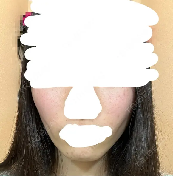 糸リフト / 脂肪吸引（顔） / ジョールファット除去 / ボトックス（エラ・小顔） ルラ美容クリニック 新宿院 DAY 127 メイン用