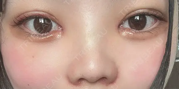 二重埋没 / 目頭切開 / 鼻尖形成（切開） / 軟骨移植 / 眉間プロテーゼ / 鼻尖縮小 グローバルビューティークリニック 大阪院 DAY 8 メイン用