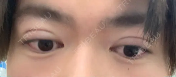 二重埋没 藤・ナチュレ美容クリニック 銀座院 DAY 0 メイン用