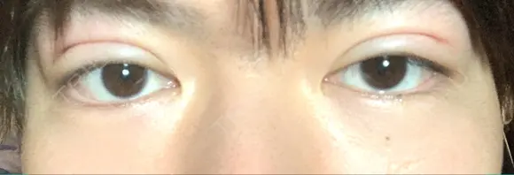 二重埋没 藤・ナチュレ美容クリニック 銀座院 DAY 1 メイン用