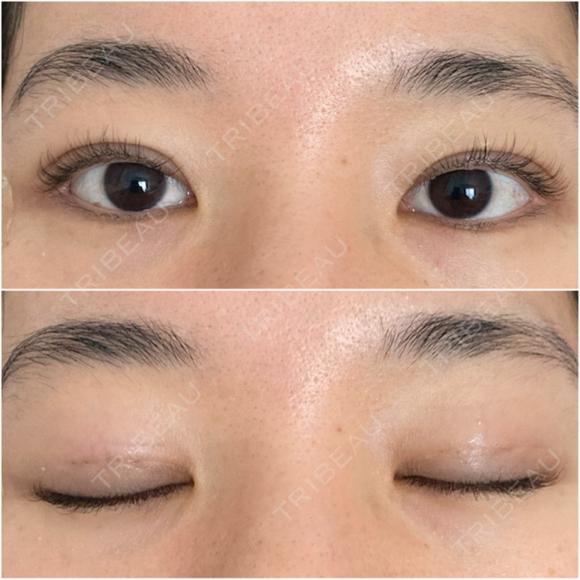 二重埋没 オアシス美容外科 DAY 6 メイン用