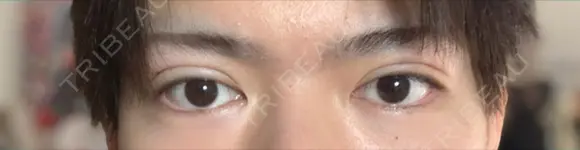 二重埋没 藤・ナチュレ美容クリニック 銀座院 DAY 2 メイン用