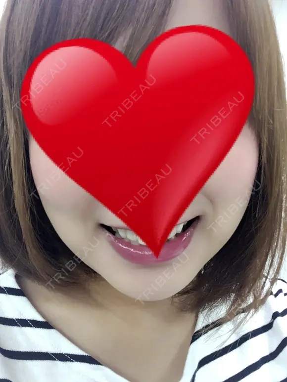 ヒアルロン酸注入（あご） 加藤クリニック麻布 大阪院 DAY 316 メイン用