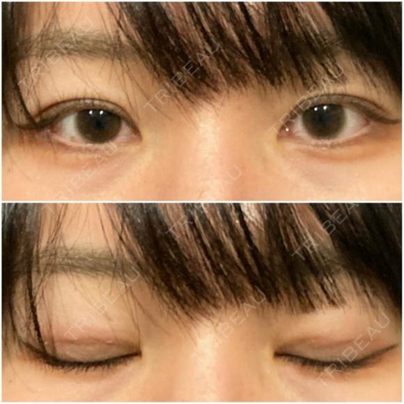二重埋没 オアシス美容外科 DAY 7 メイン用
