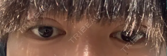 二重埋没 藤・ナチュレ美容クリニック 銀座院 DAY 3 メイン用