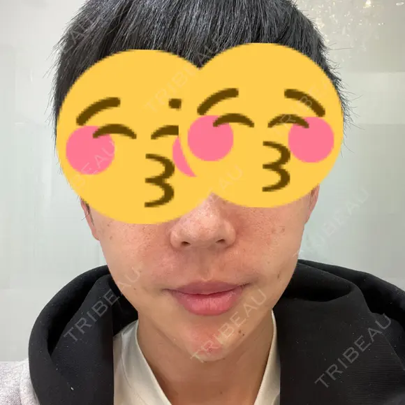 ボトックス（あご） / ヒアルロン酸注入（あご） / ヒアルロン酸注入（鼻翼基部） シェリークリニック 新宿本院 DAY 0 メイン用