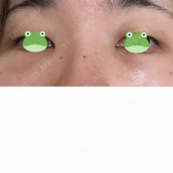 クマ治療 / 脂肪注入（肌） X CLINIC 大阪院 DAY 1 メイン用